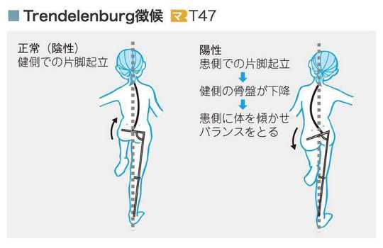 横に倒すと痛い腰痛の原因と治療について 春日井で腰痛なら鍼灸マッサージ室ゆうせん