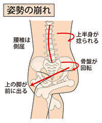 横に倒すと痛い腰痛の原因と治療について 春日井で腰痛なら鍼灸マッサージ室ゆうせん